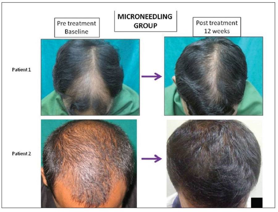 Before and After photos of minoxidil group + dermaroller