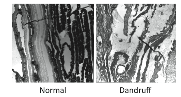The scalp with and without dandruff