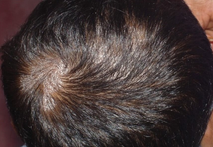 Ringworm Scalp Tinea Capitis Condition Treatments and Pictures for  Children  Skinsight