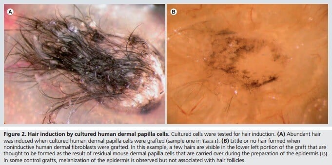 Grafted hair results