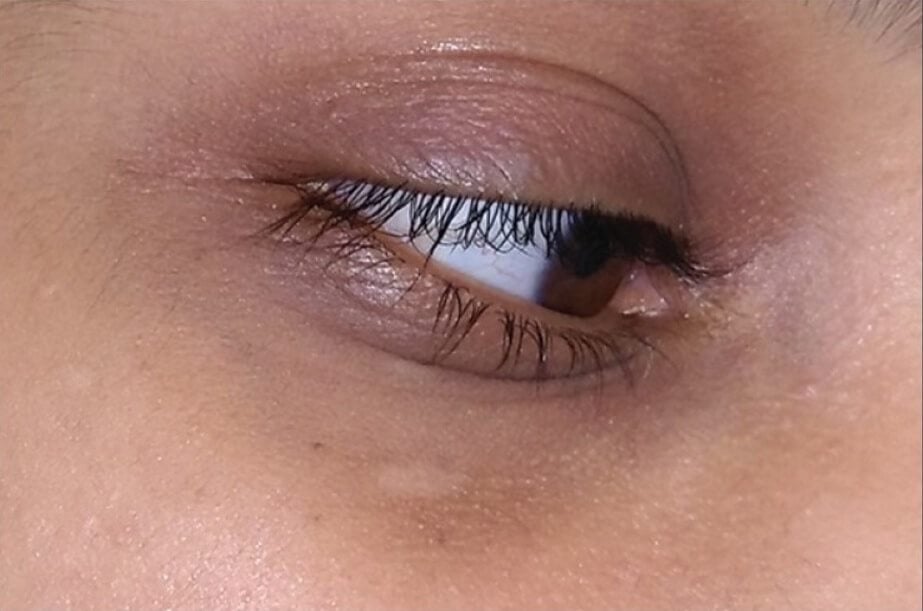 Biopsy hyperpigmentation