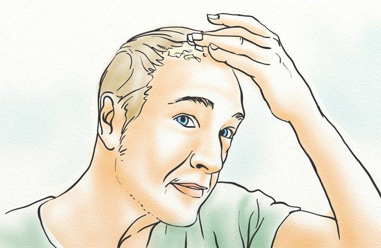 It can cause itchiness on the scalp