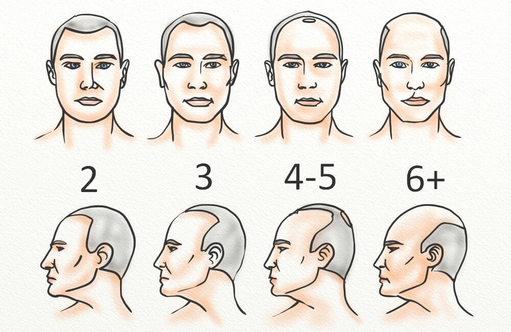 Receding Hairline Regrowth How To Prevent Recession Hairguard Receding Hairline Regrowth How To Prevent Recession Hairguard