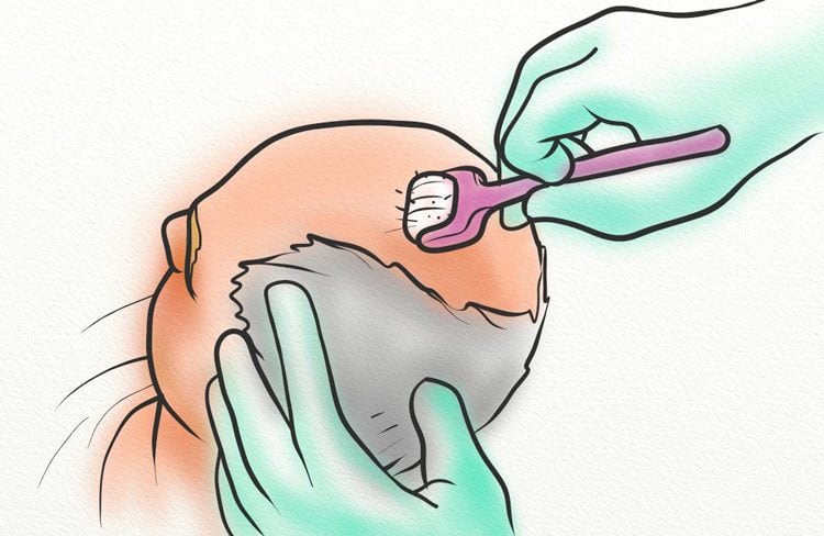 A man with a large bald spot receiving microneedling