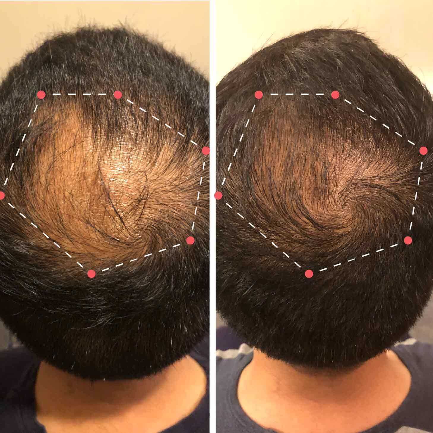 Dermaroller Hero Image-02