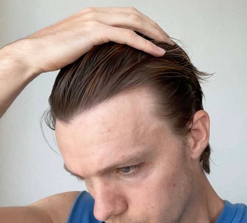 Will at age 36, after ten years of consistent Growband Pro use