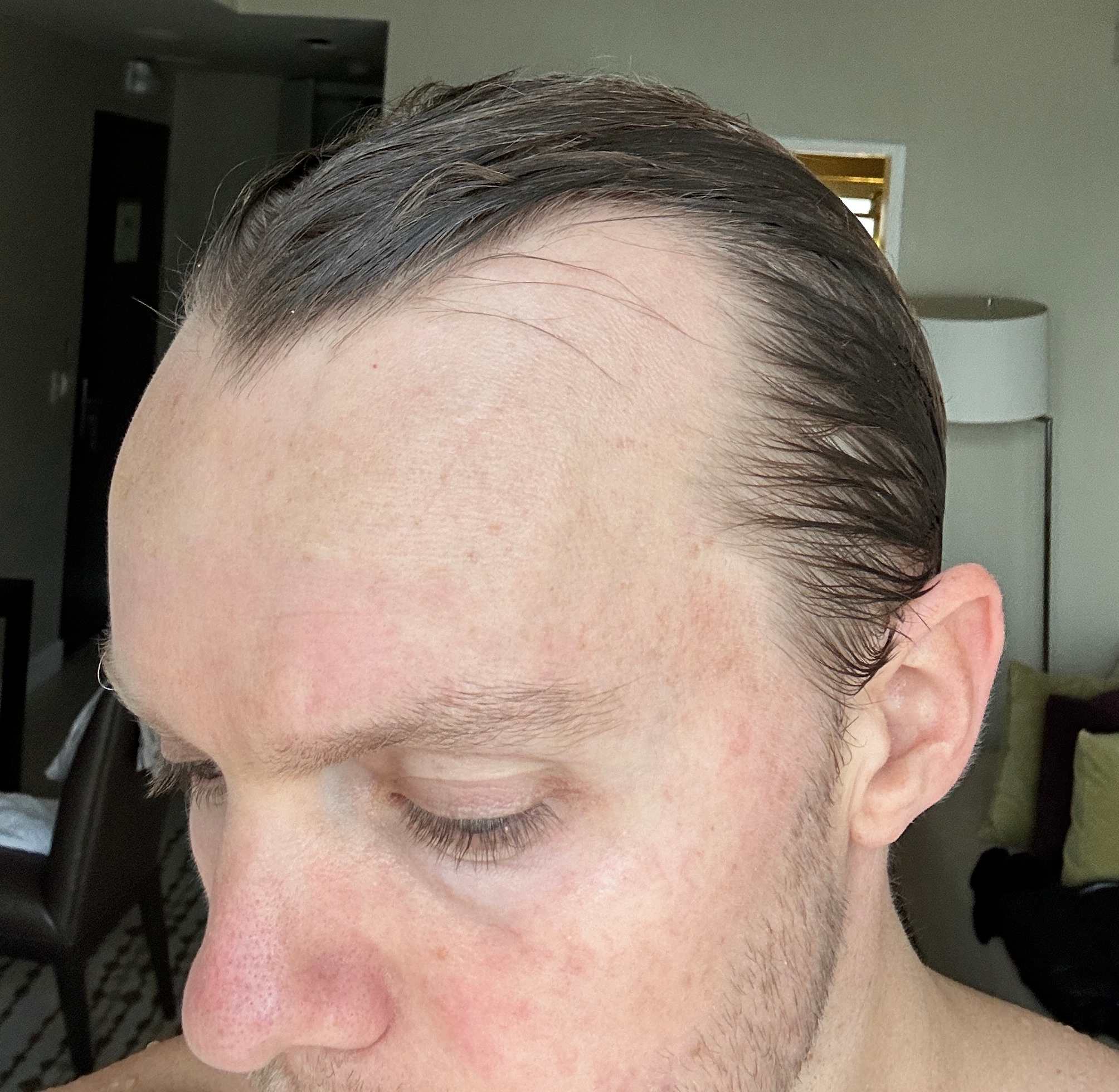 Will at age 26, before using the Growband Pro to reduce scalp tension